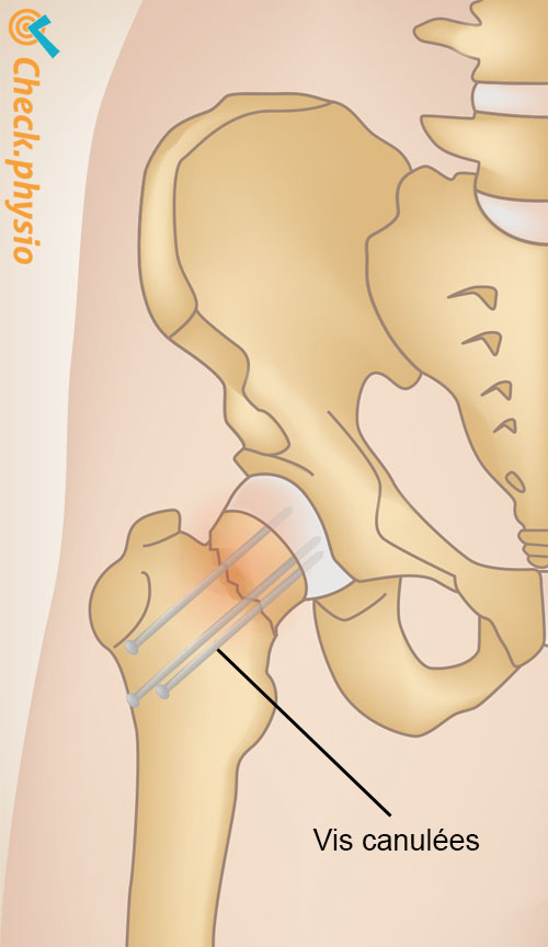 hanche fracture hanche fixation vis