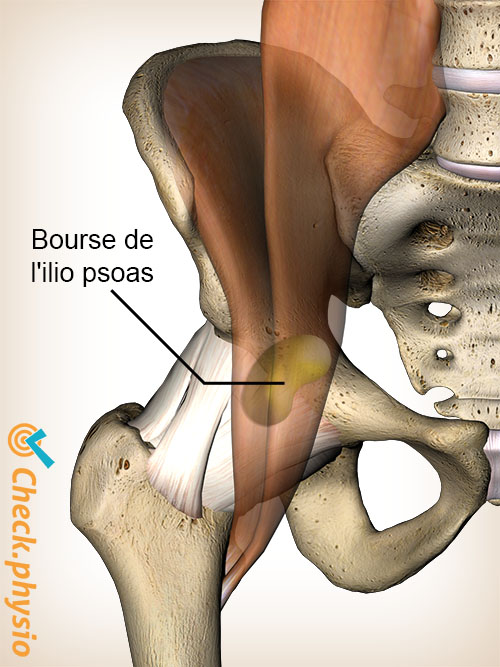 hanche bourse iliopsoas bursite