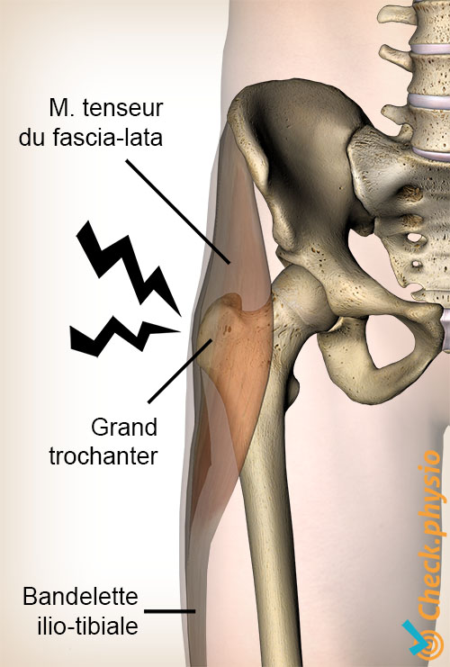 hanche syndrome douloureux du grand trochanter anatomie tenseur du fascia lata bandelette ilio-tibiale