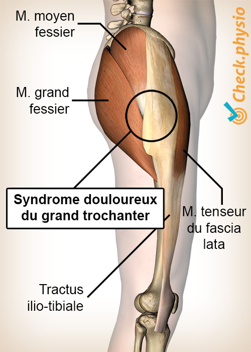 hanche syndrome douloureux du grand trochanter anatomie
