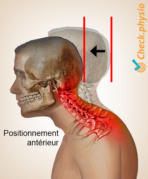 syndrome postural cervical tête cou antériorisation