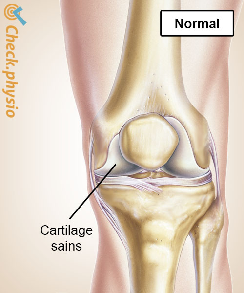 genou arthrose cartilage sain