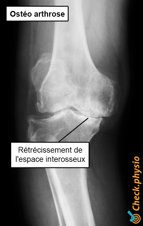 genou arthrose radiographie