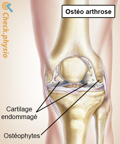 genou arthrose usure cartilage