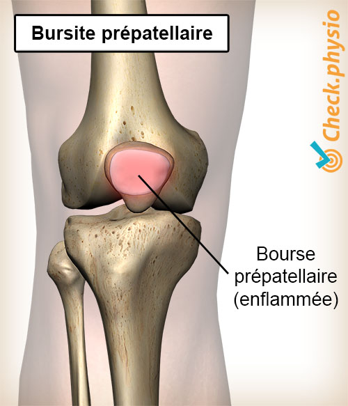 genou bursite prépatellaire bourse enflammée bourse séreuse patella