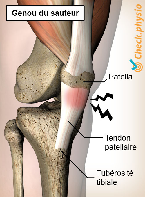 genou genou du sauteur douleur tendon patellaire tendinite