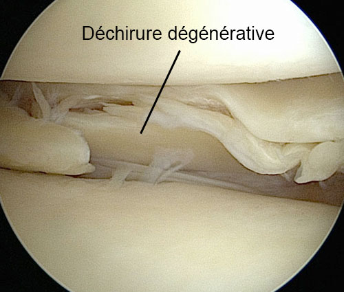 genou ménisque dégénérescence dégénératif