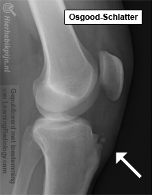 genou Osgood-Schlatter radiographie