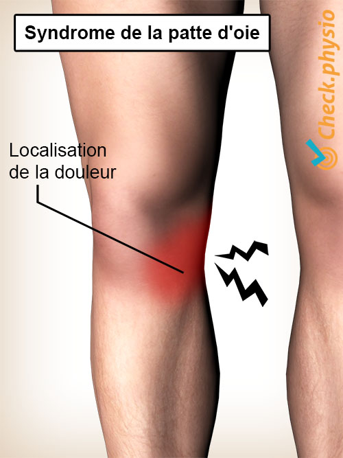 genou syndrome de la patte d'oie localisation de la douleur