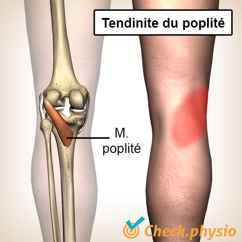 genou tendinite du poplité