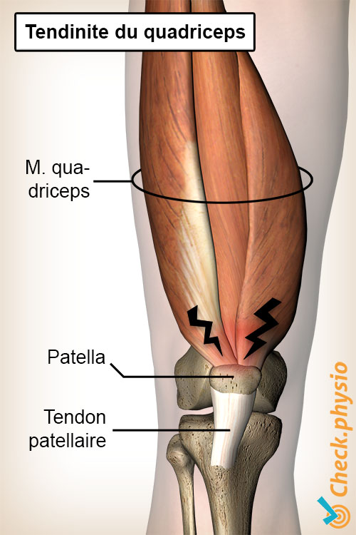 genou tendinite du quadriceps anatomie