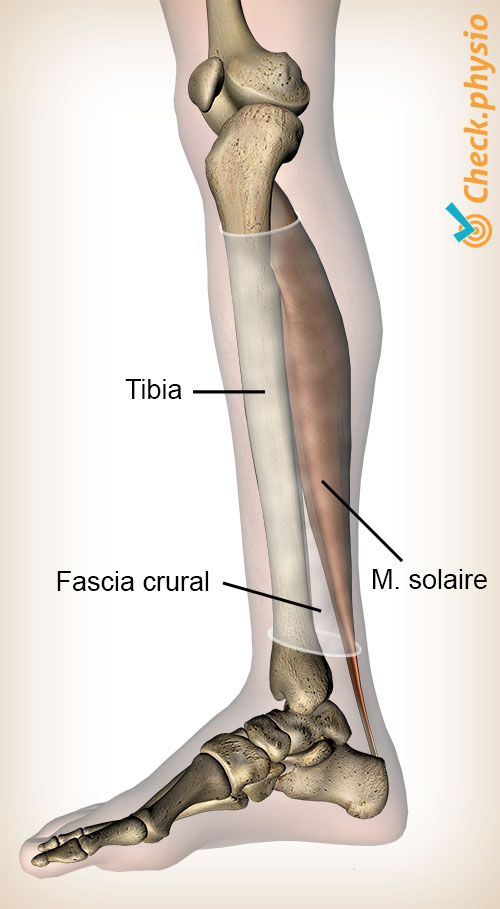 syndrome de stress tibial médial