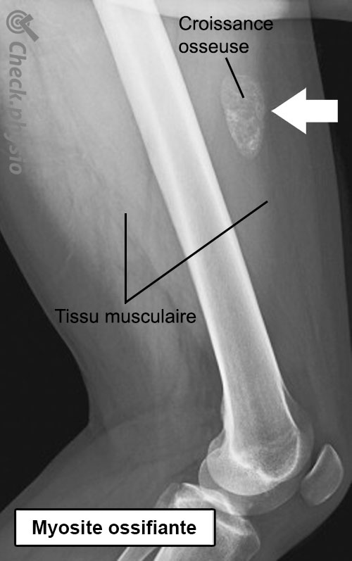 myosite ossifiante radiographie anatomie
