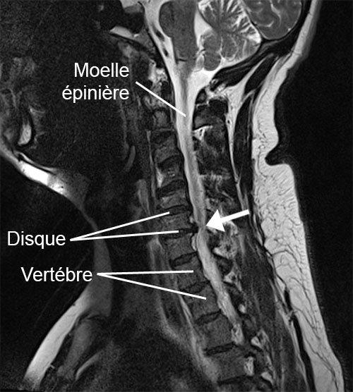 cou radiculopathie cervicale hernie cervicale molle