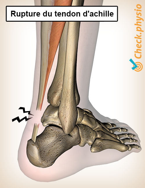 jambe rupture du tendon d'Achille