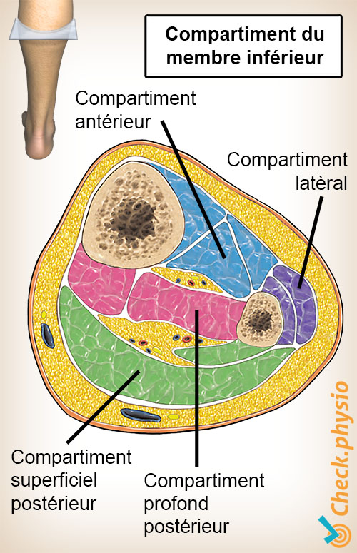 jambe syndrome des loges coupe transversale des compartiments musculaires