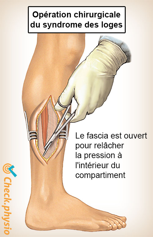 jambe syndrome des loges opération