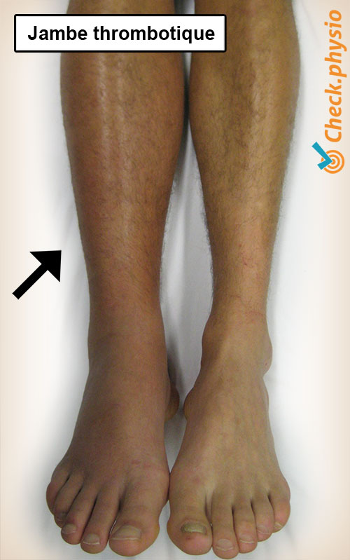 jambe jambe thrombotique thrombose gonflement
