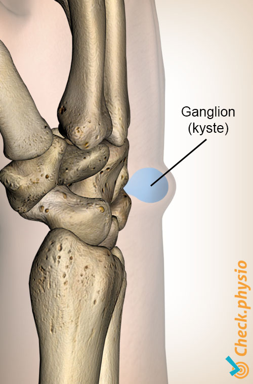 poignet kyste ganglionnaire anatomie
