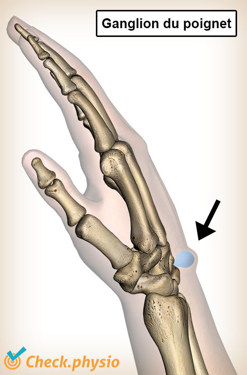 poignet ganglion gonflement bosse anatomie kyste mucoïde