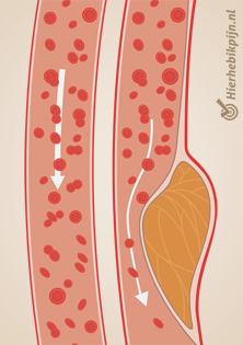 artériosclérose artère calcification artérielle
