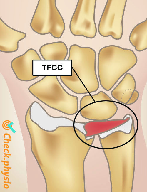 poignet TFCC