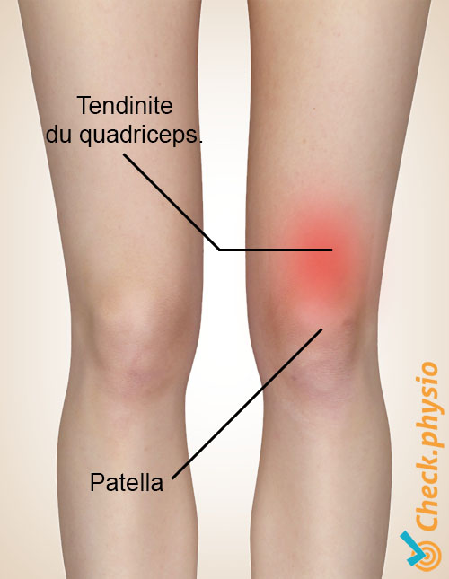 tendinite du quadriceps
