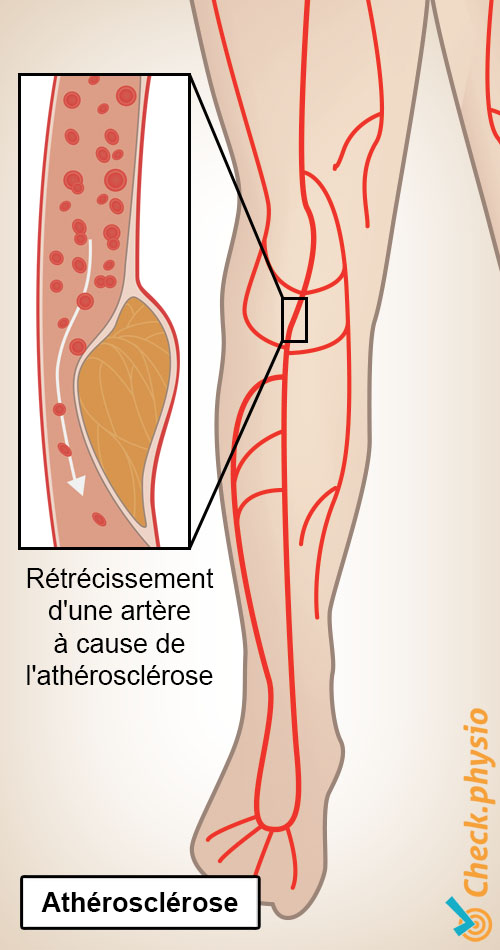 jambe jambes-vitrine claudication intermittente formation de plaque