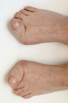polyarthrite rhumatoïde pieds