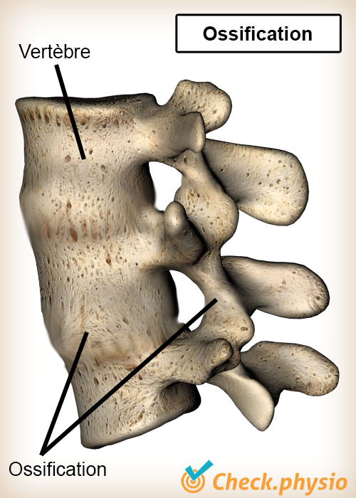 dos Bechterew ossification des vertèbres