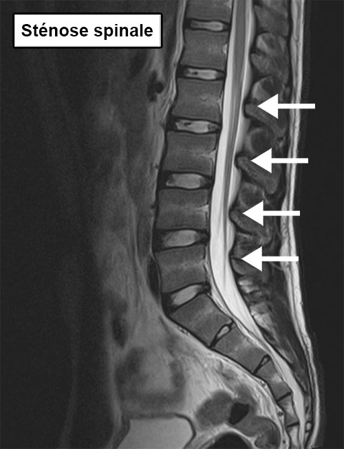 dos colonne lombaire radiographie sténose du canal rétrécissement