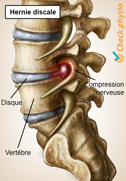 dos douleur lombaire spécifique hernie discale
