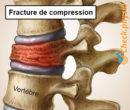 dos douleur lombaire spécifique vertèbre affaissée