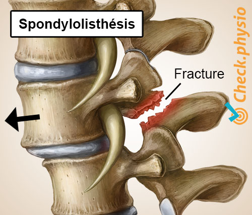 dos douleur lombaire spécifique spondylolisthésis vertèbre déplacée