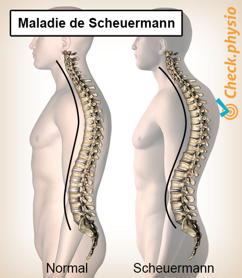 dos maladie de Scheuermann posture colonne vertébrale courbure cyphose