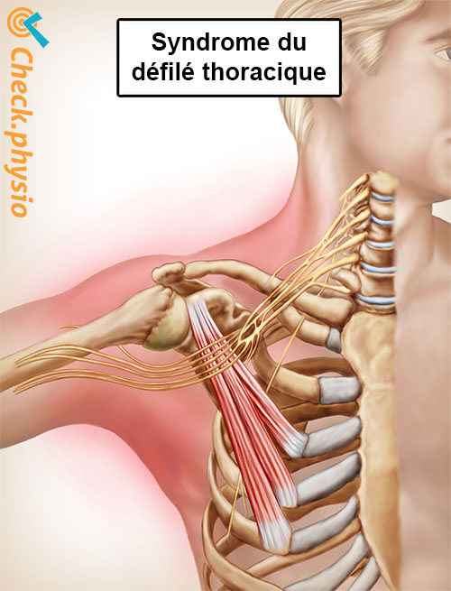 épaule bras main syndrome du défilé thoracique anatomie