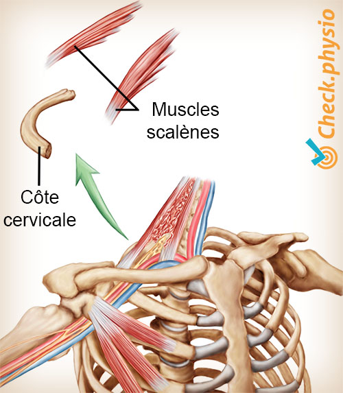 épaule bras main syndrome du défilé thoracique côte cervicale