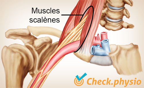 épaule bras main syndrome du défilé thoracique triangle des scalènes