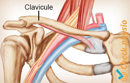 épaule bras main syndrome du défilé thoracique clavicule