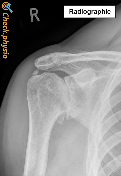 épaule arthrose radiographie