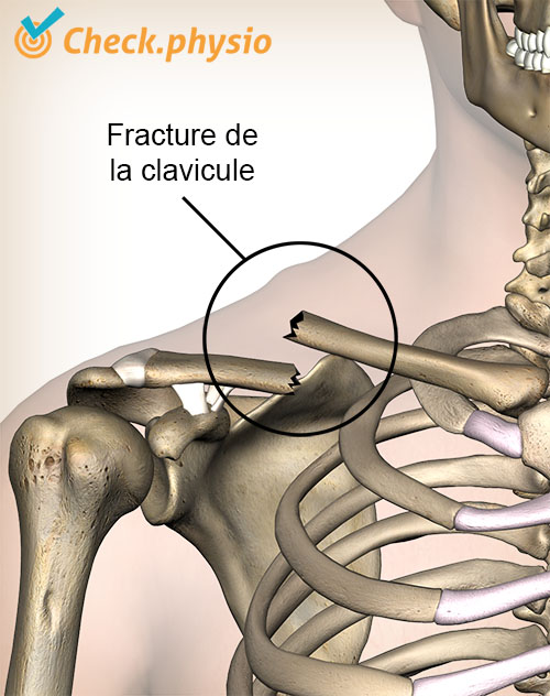épaule fracture de la clavicule cassure de la clavicule