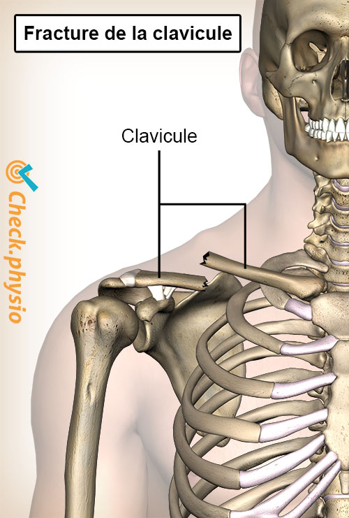 épaule fracture de la clavicule clavicule cassée