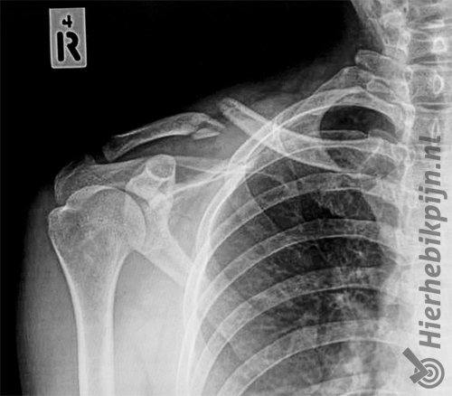 épaule fracture de la clavicule radiographie de fracture de la clavicule
