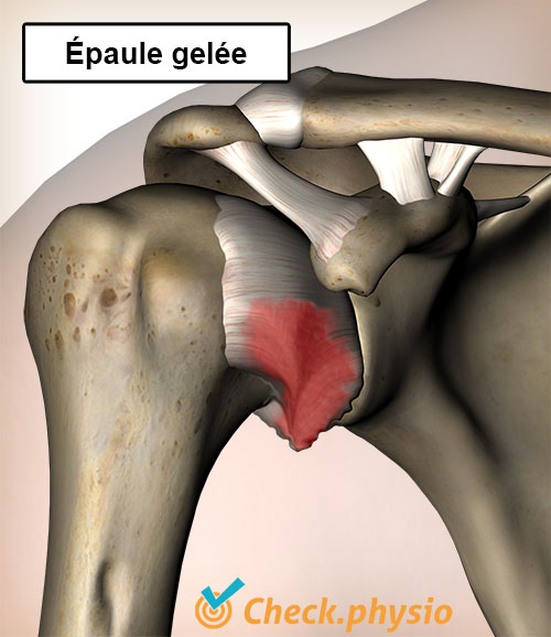 épaule épaule gelée