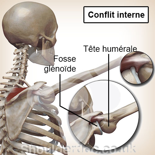épaule conflit interne tête humérale cavité glénoïde coincement