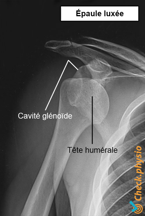épaule radiographie luxation