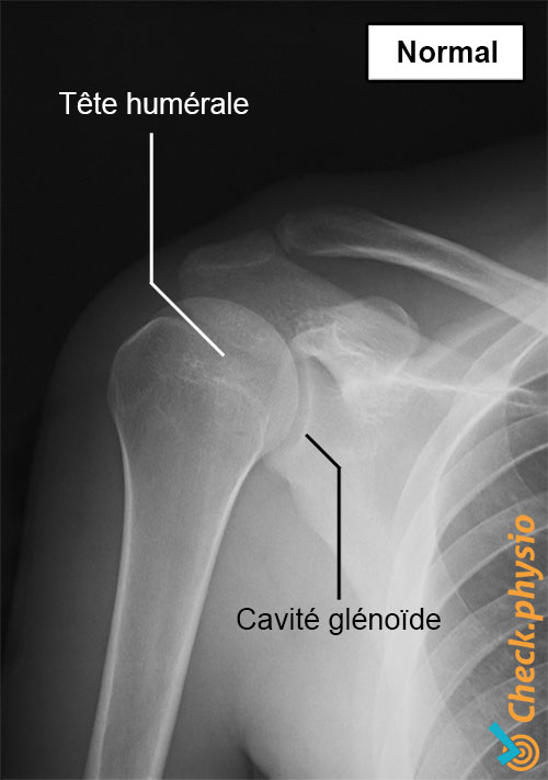 épaule radiographie normale