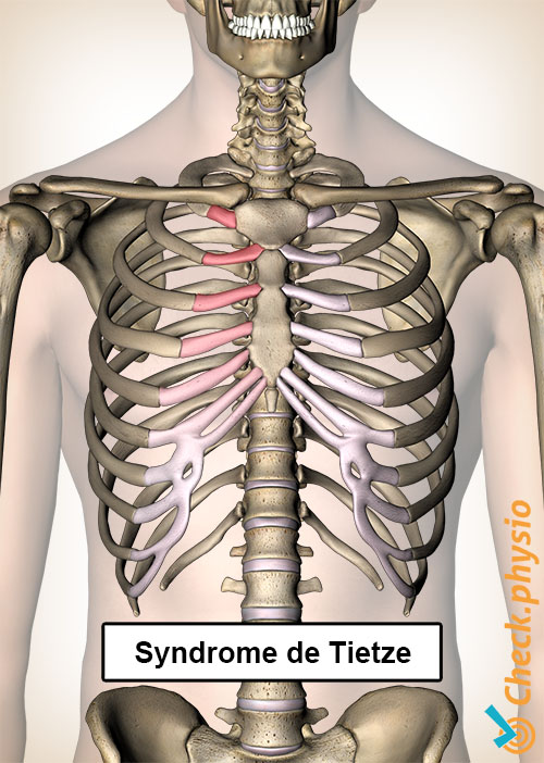 syndrome de Tietze côtes douleur poitrine sternum