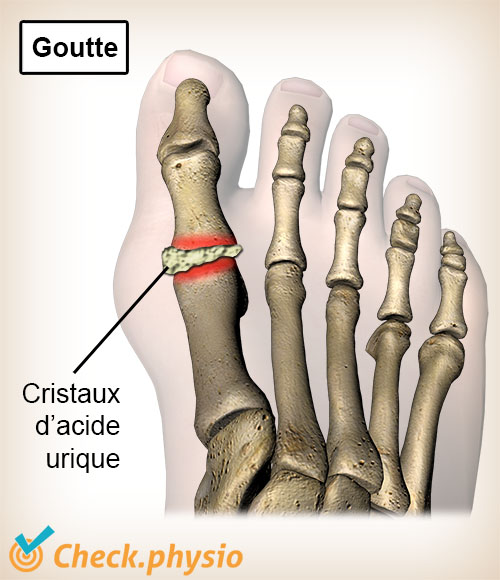 orteil goutte cristaux d'acide urique