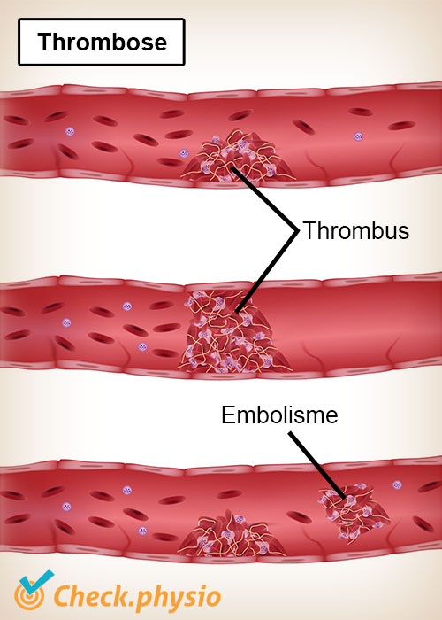 thrombose thrombus embolie vaisseau sanguin veine artère